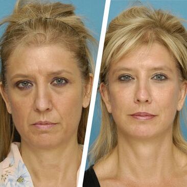 A experiencia de Natalia de Kyiv, foto antes e despois de usar Intenskin