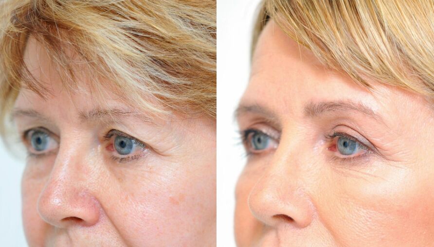 blefaroplastia-antes-e-despois
