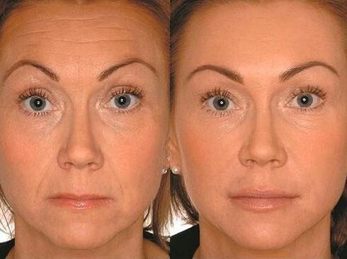 Antes e despois da terapia con microcurrent